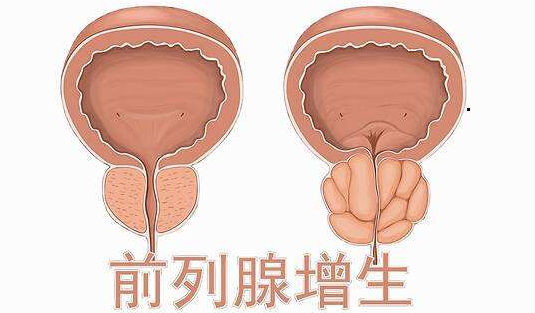 前列腺肥大图片原因图片